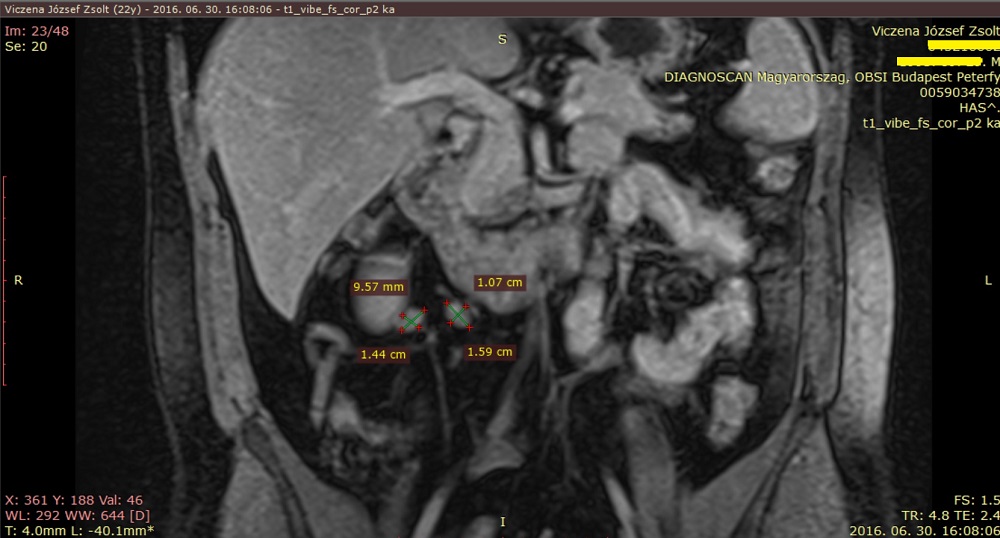 teljes has-kismedence MR vizsgálat, nyirokcsomó megnagyobbodás, limfadenitisz, Affidea OBSI