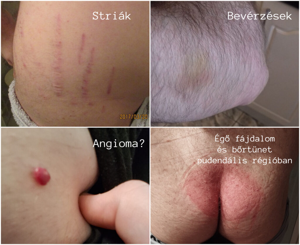 Bartonellózis (Bartonella Henselae) bőrtünetei és érrendszeri tünetei: striák, angioma, bevérzés, neuropátia