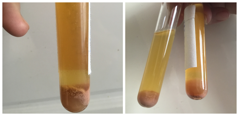 Kémcsőben véres, gennyes vizelet: vérvizelés (makroszkópos hematuria), fehérjevizelés (proteinuria), gennyvizelés (pyuria, fehérvérsejtek a vizeletben), kristályürítés - hypercalciuria, hyperoxaluria, albuminuria. Magas vizelet kreatinin és összfehérje szint. Összefoglalóan: súlyos vesemedence-gyulladás jelei vizeletben.