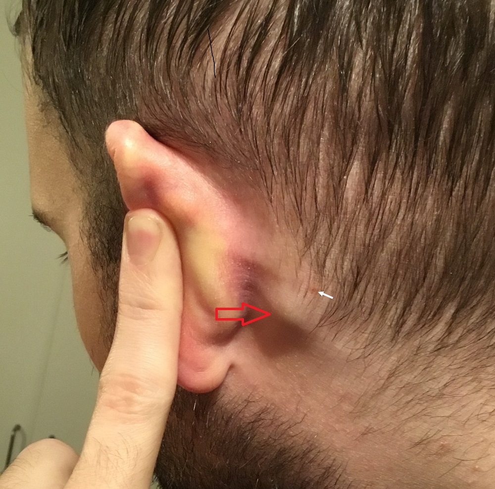 cervicalis limfadenopátia, fül mögötti (retroauricularis) nyirokcsomó-megnagyobboás mintavétele; dr Székely Eszter