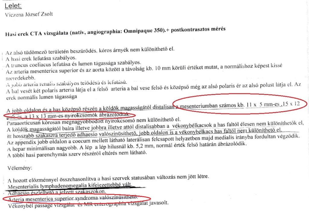 hasi CT angiográfia, lelet, artéria mesenterica superior szindróma, hasi nyirokcsomó-megnagyobbodás (mesenterialis limfadenopátia)