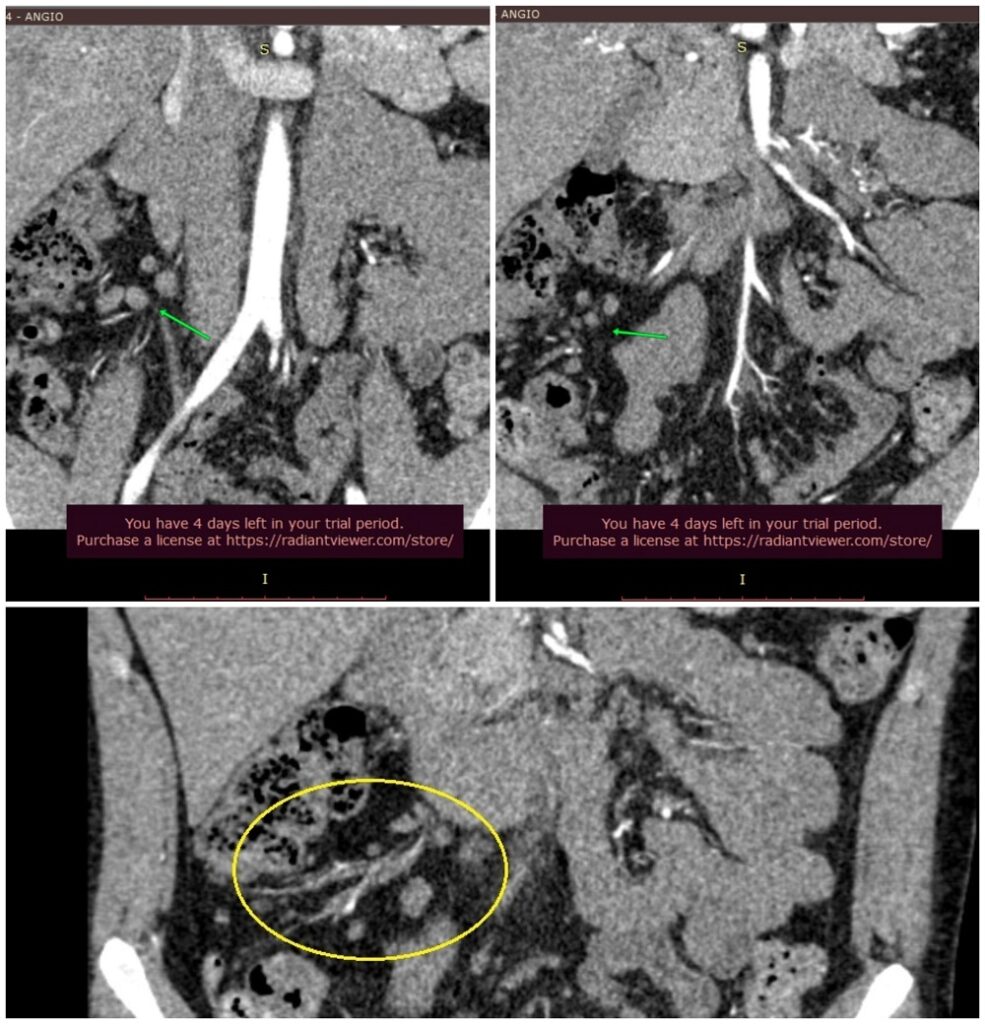 Viczena Zsolt CT angiográfia vizsgálata: hasi nyirokcsomók megnagyobbodása, mesenterialis lymphadenomegalia, limfadenitisz, limfadenopátia; Affidea CT vizsgálat