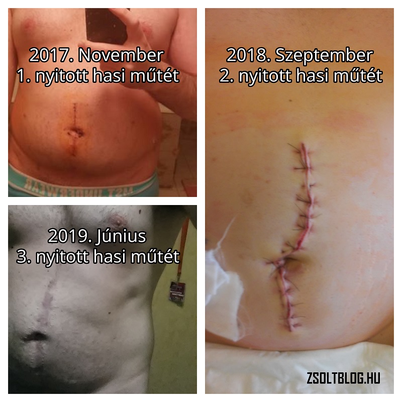 Anton Stift, chirurgie, AKH Wien, nyitott nagy hasi műtét, laparotomia, Semmelweis Transzplantációs Klinika - Dr Piros László sebész, Semmelweis Egyetem I. számú Sebészeti Klinika (STÉG) - Dr Molnár Béla Ákos, Dr Rose Magánkórház