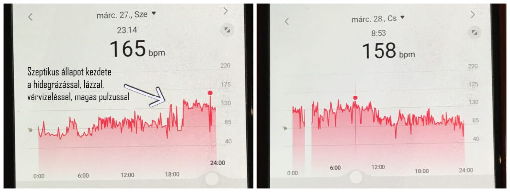 Vesemedence-gyulladás szepszisig fajul: A felszálló fertőzés hidegrázás, láz, vérnyomás-esés mellett nagyon magas pulzust produkált. (Pulzus ábra 2024. március 27-28-án)