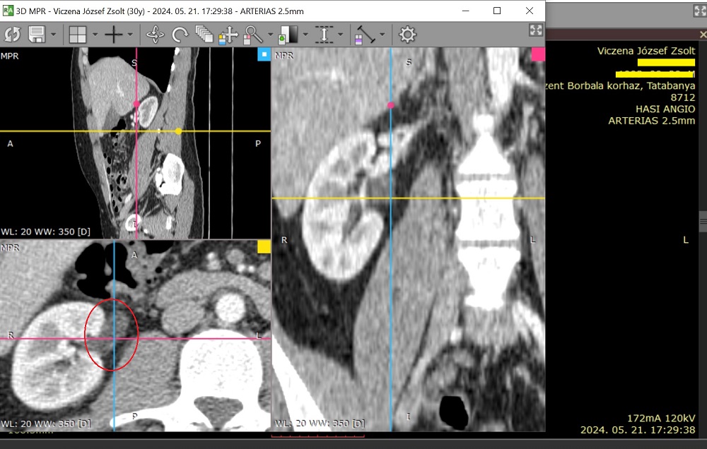 Hosszan tartó kezeletlen vesemedence-gyulladás következménye: vesén kívülre kicsúszott vesemedence, avagy extrarenalis pyelon a CT képein.
