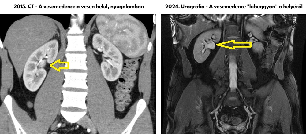 Kezeletlen gyulladástól "kicsúszott" vesemedence (extrarenalis pyelon) összehasonlítása a beteg korábbi CT felvétel