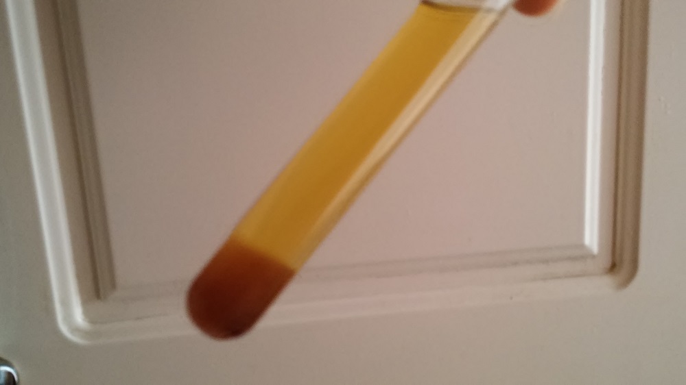 véres vizelet minta (kémcsőben), makroszkópos vérvizelés, gross hematuria