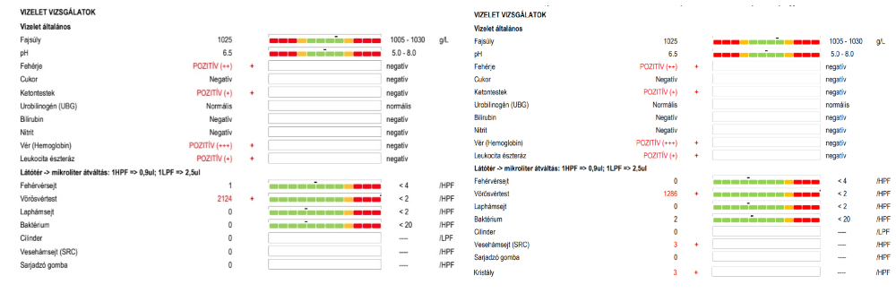 Vesemdence-gyulladás laborjelei: Synlab vizeletvizsgálat lelet: masszív hematuria (vérvizelés), fehérjevizelés, leukocita észteráz pozitivitás - ez szinte mindig vesefertőzésre utal. Pyelonephritis lehet a diagnózis.