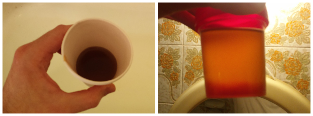 nagyfokú vérvizelés (makroszkópos hematuria) levett minta: A vesemedence gyulladás egyik vezető tünete, másnéven pyelonephritis legsúlyosabb jele