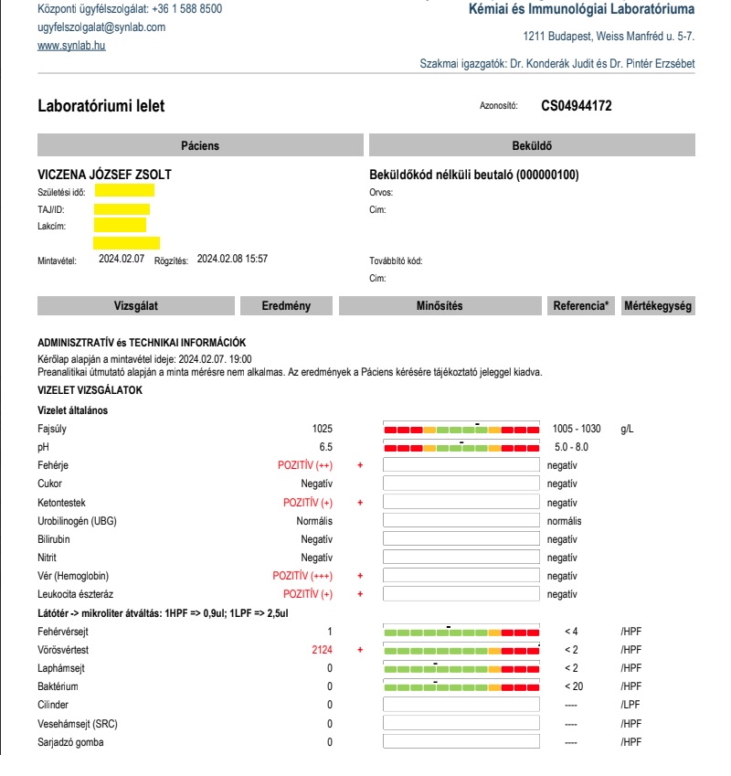 Vesemedence-gyulladás lelet a Synlab vizeletvizsgálatról: Vérvizelés, gross (makroszkópos) hematuria, vörösvértestek zsúfolva (2124/látótér), fehérjevizelés, leukocita észteráz pozitív